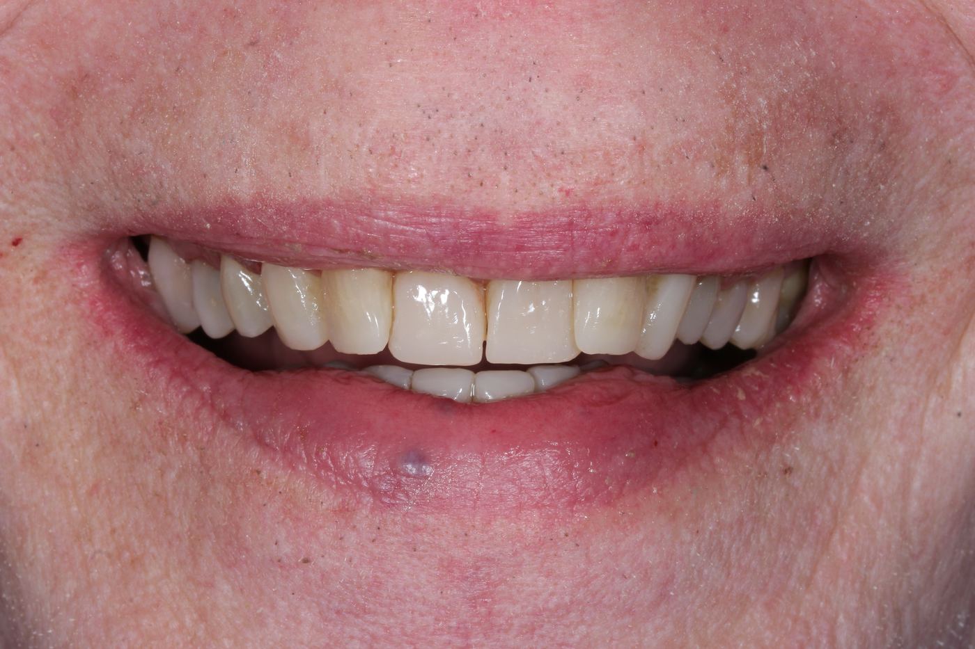 After treatment: composite and porcelain crowns by Dr Steve Conteh