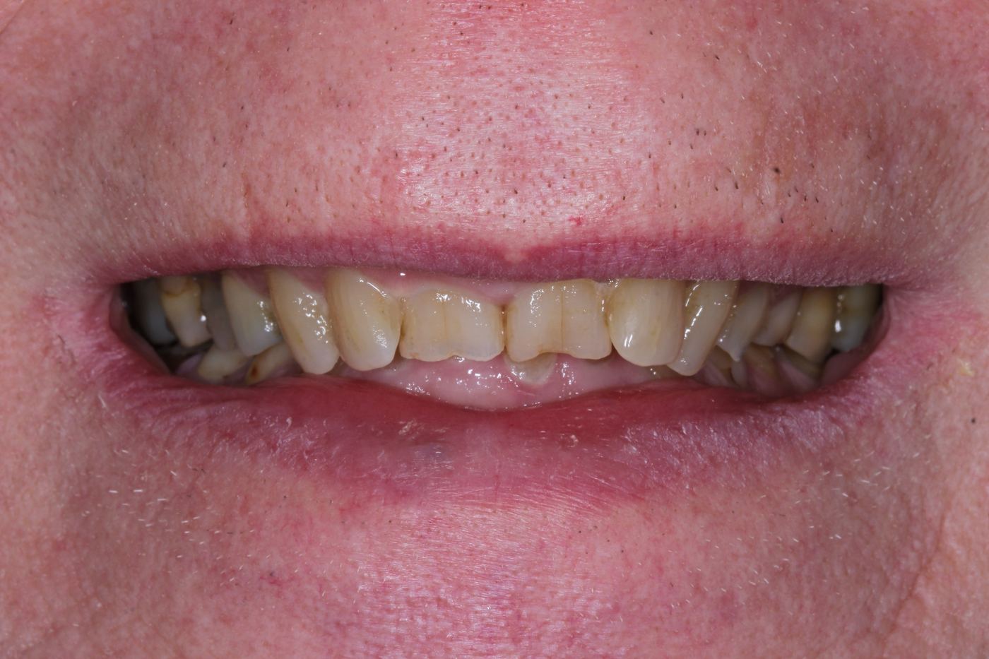 Before treatment: composite and porcelain crowns by Dr Steve Conteh