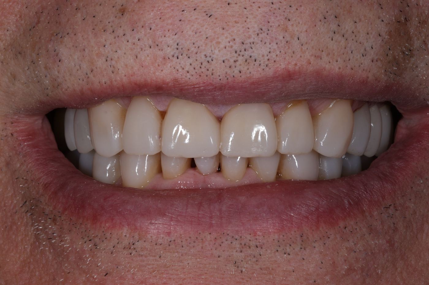 After treatment: full-mouth composite rebuild by Dr Steve Conteh