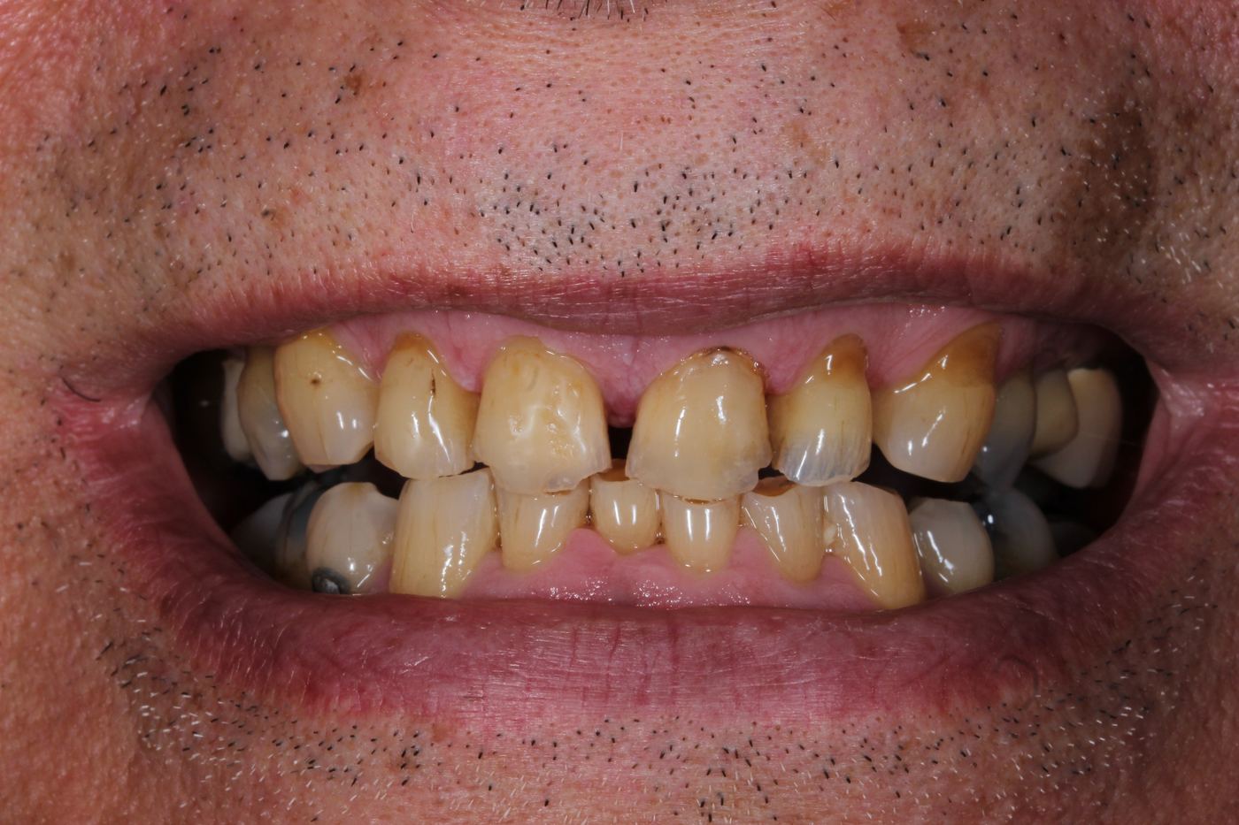 Before treatment: full-mouth composite rebuild by Dr Steve Conteh