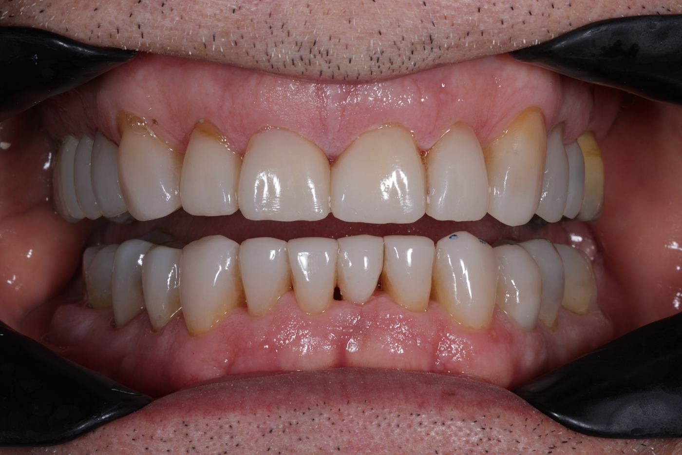 After treatment: rebuild, close view by Dr Steve Conteh