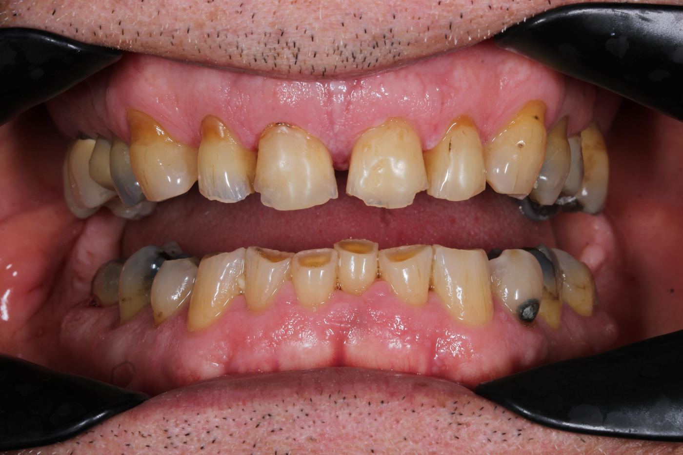 Before treatment: rebuild, close view by Dr Steve Conteh