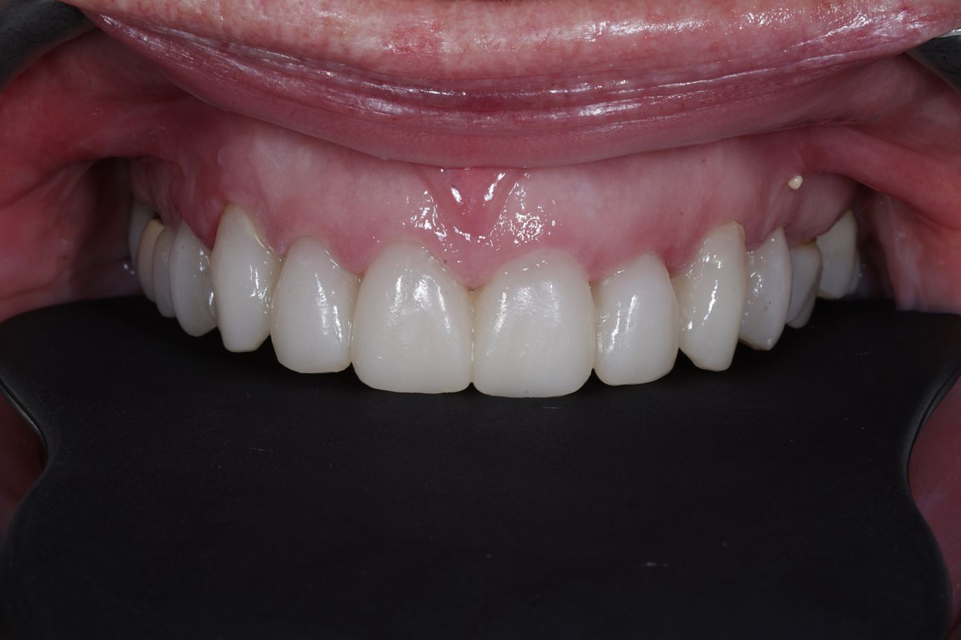 After treatment: trial smile in temporary veneers by Dr Steve Conteh