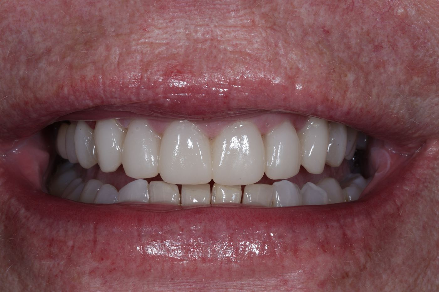 Before treatment: trial smile in temporary veneers by Dr Steve Conteh