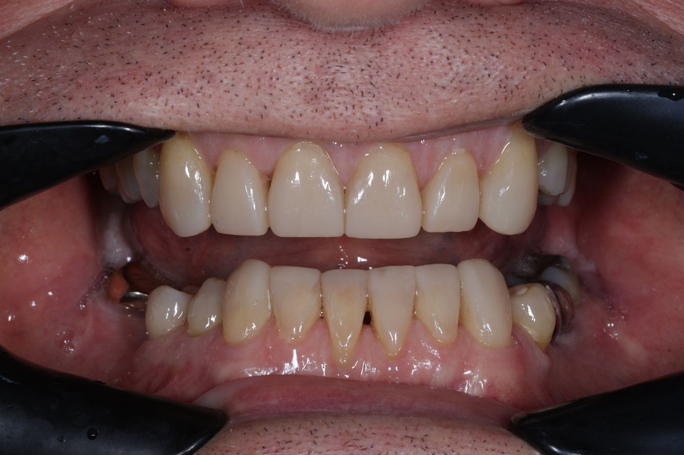 After treatment: front twelve teeth restored by Dr Steve Conteh