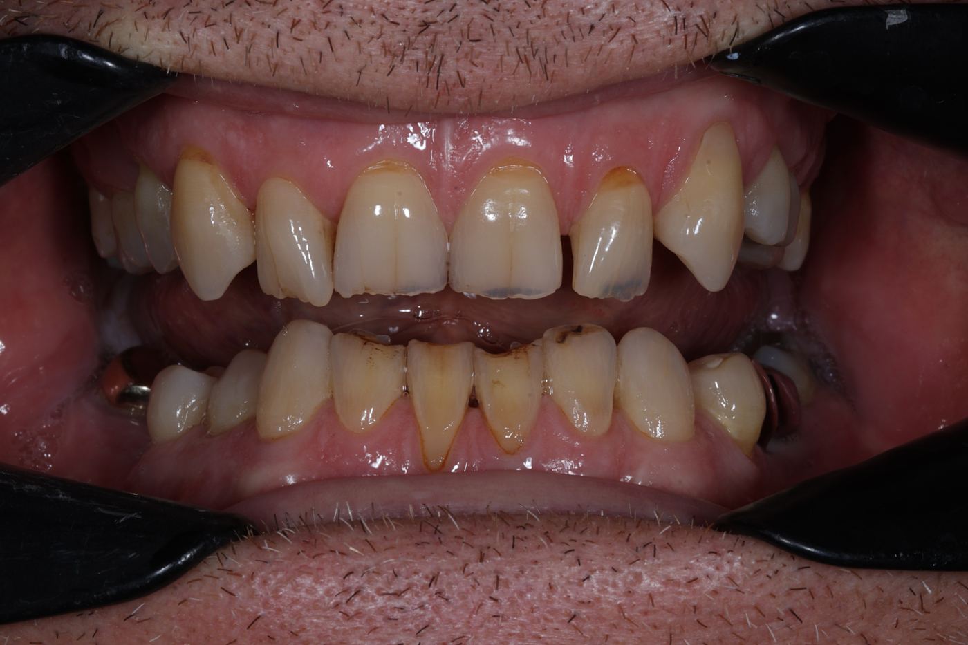 Before treatment: front twelve teeth restored by Dr Steve Conteh