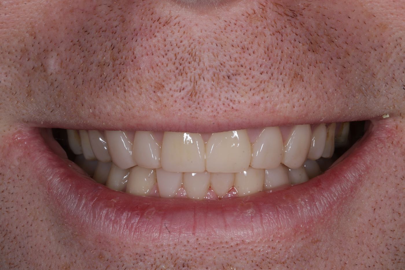 After treatment: reversing wear with composite by Dr Steve Conteh