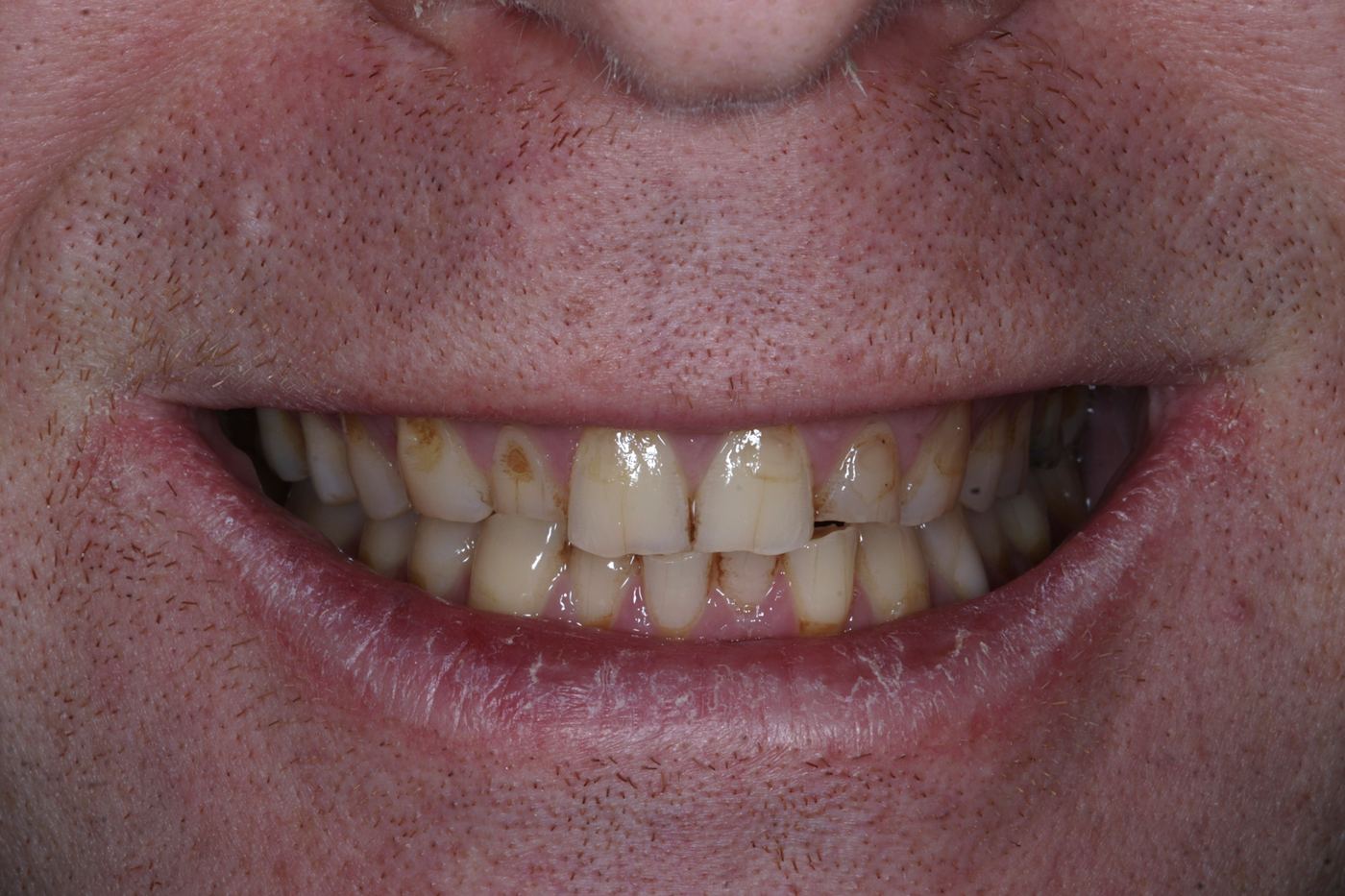 Before treatment: reversing wear with composite by Dr Steve Conteh