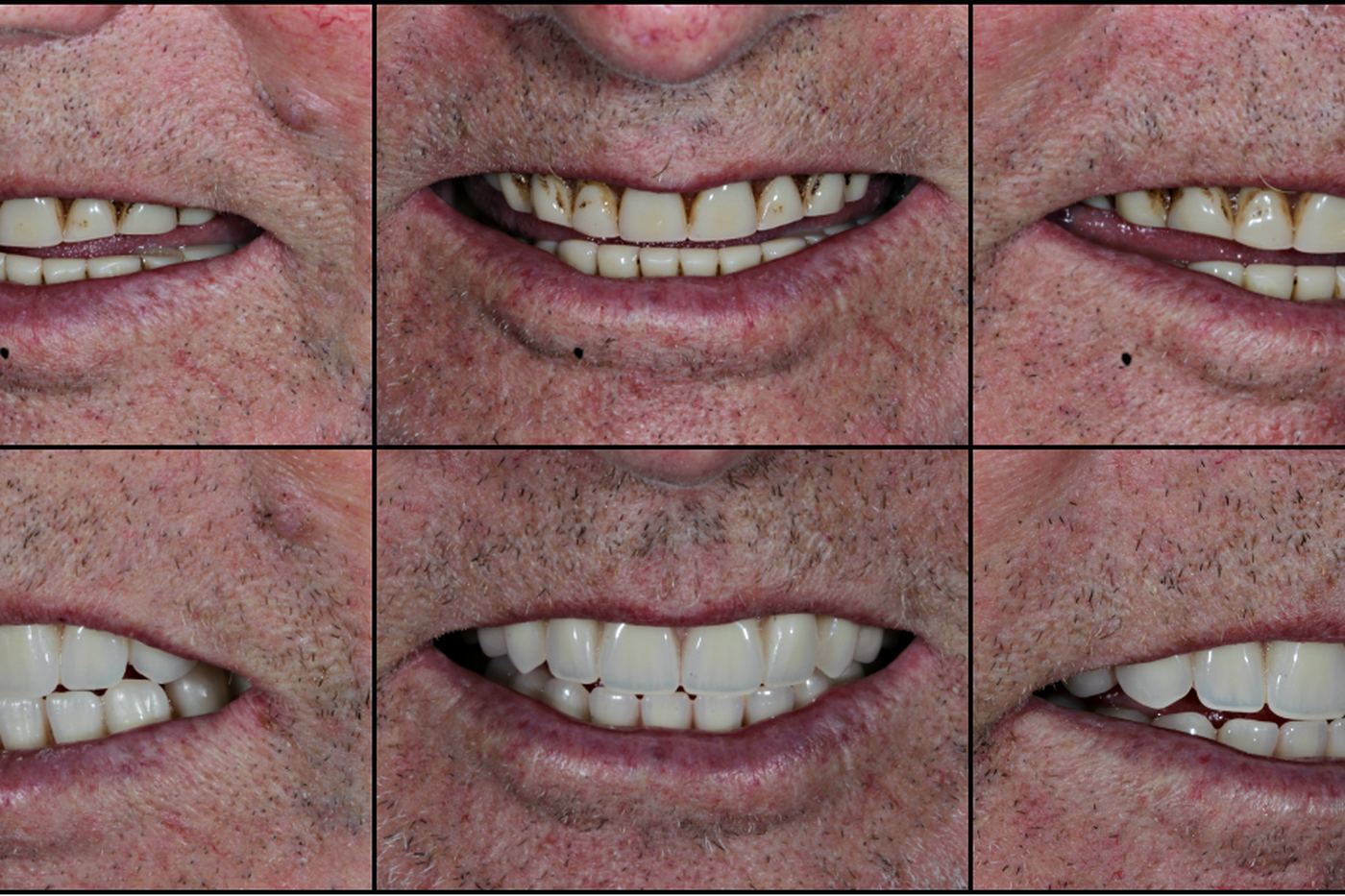 Full-arch implant rehabilitation before and after, by Dr Steve Conteh