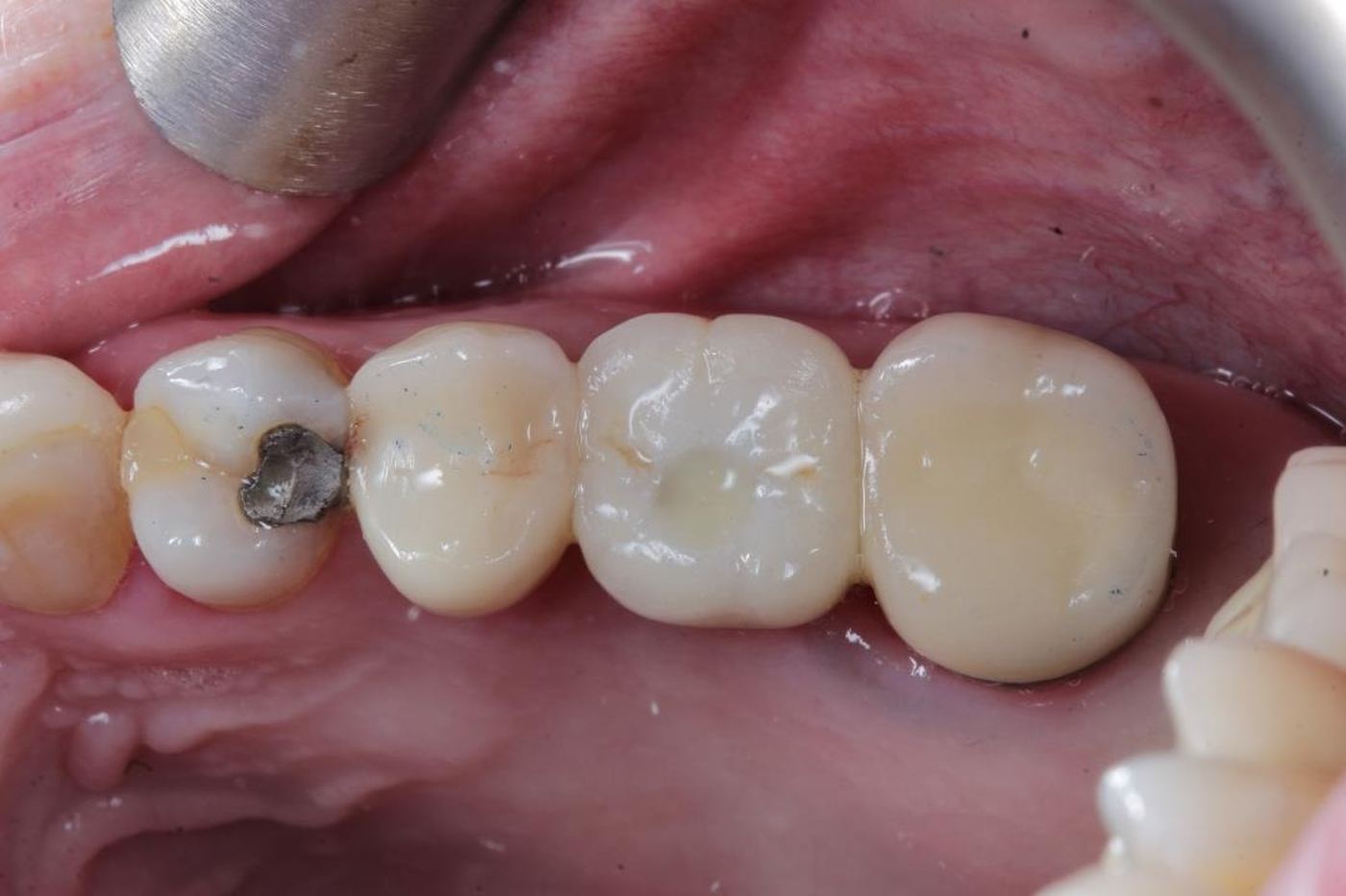 Implant-supported crown replacing a lower molar, restored by Dr Steve Conteh