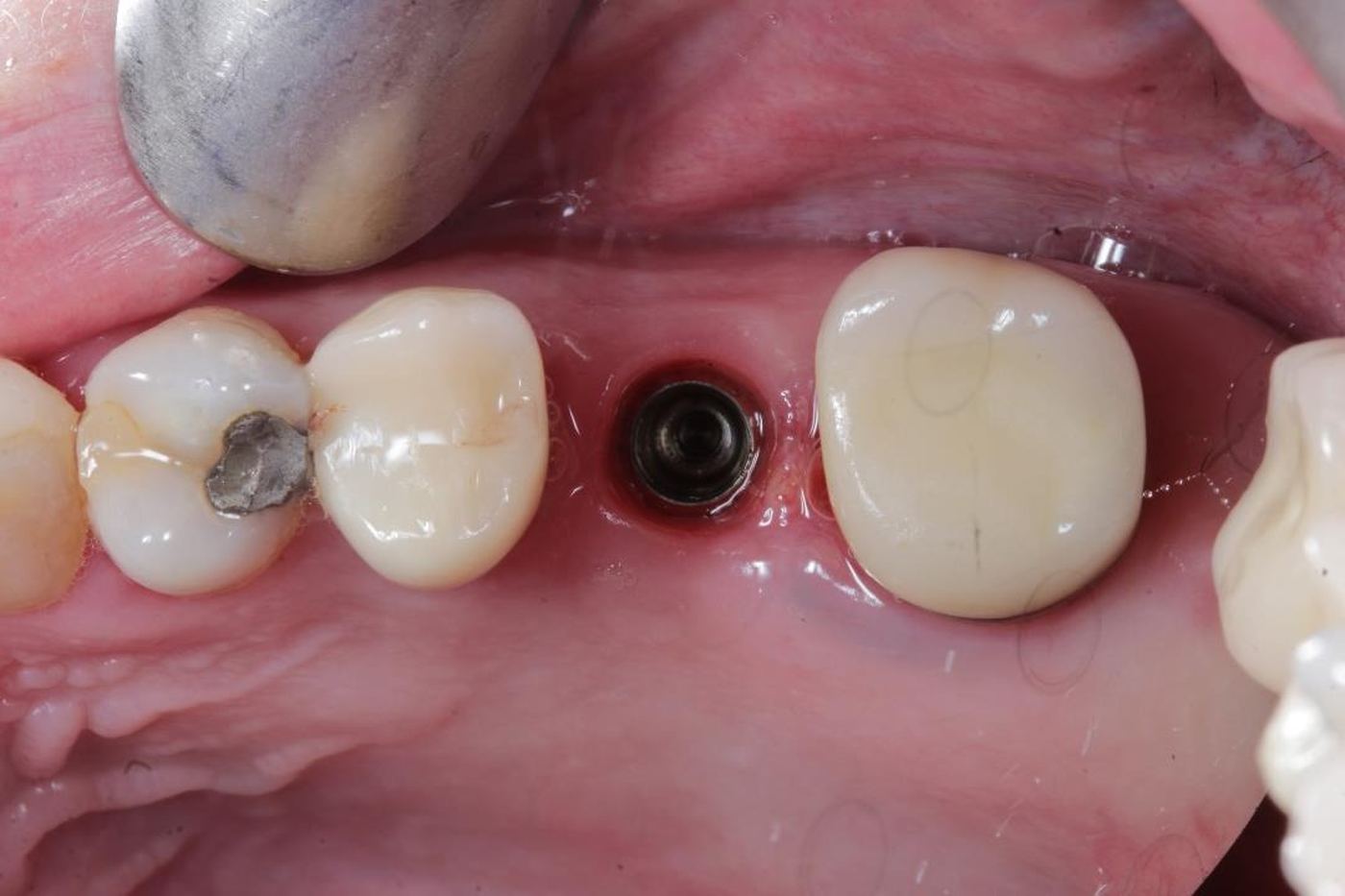 Radiograph showing a placed dental implant, Dr Steve Conteh