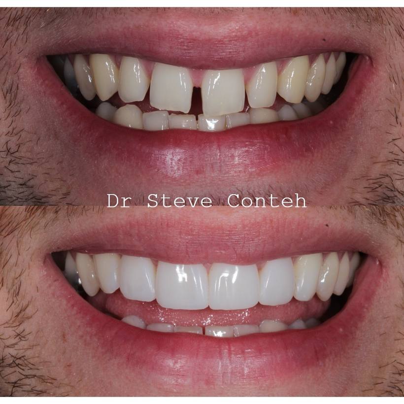 Whitening improved the colour, and composite bonding closed the gaps to enhanced this smile