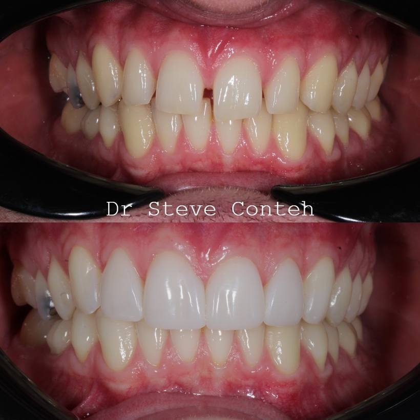 Whitening improved the colour, and composite bonding closed the gaps to enhanced this smile