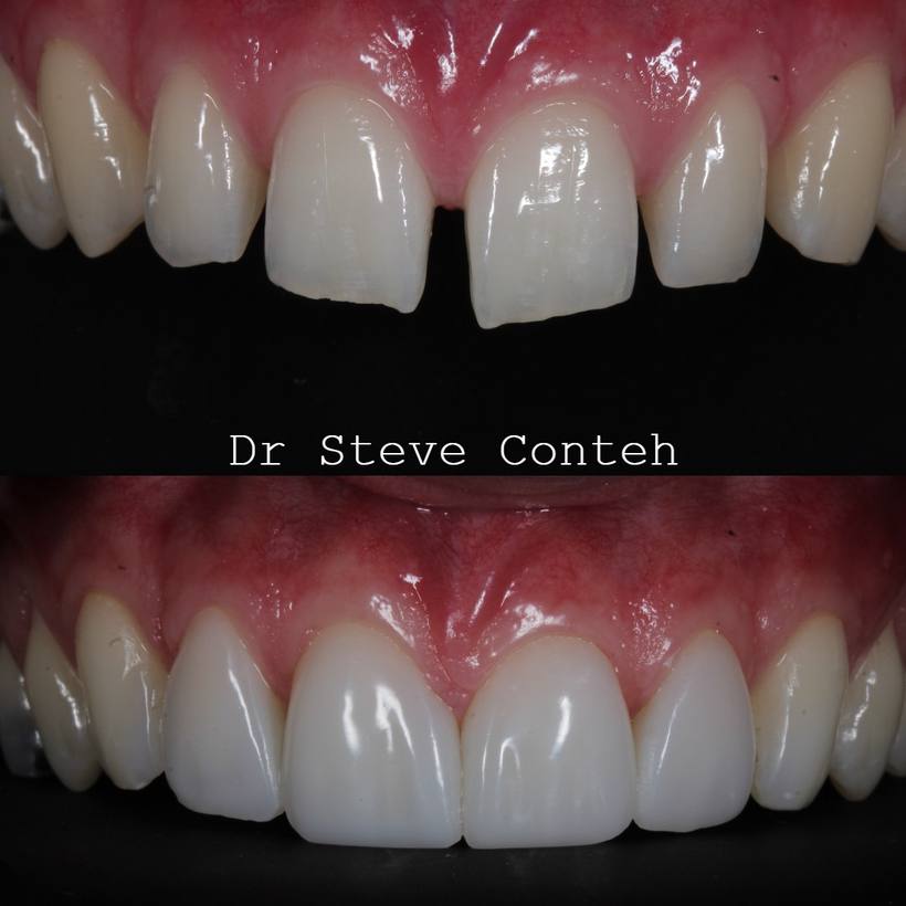 Whitening improved the colour, and composite bonding closed the gaps to enhanced this smile