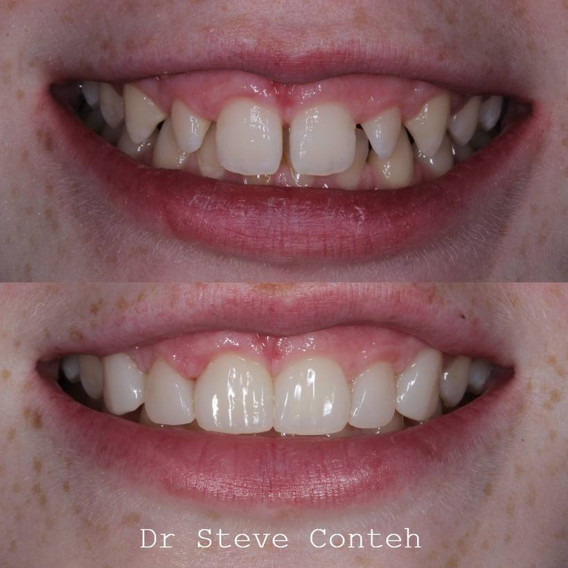 Composite bonding was used here to close the spaces, improve the shape of the teeth and provide a natural result.