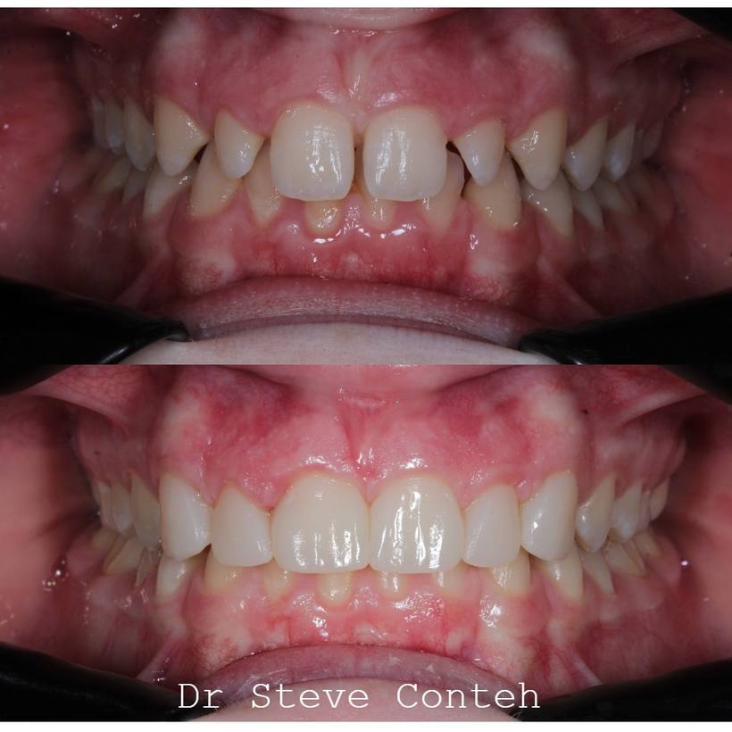 Composite bonding was used here to close the spaces, improve the shape of the teeth and provide a natural result.