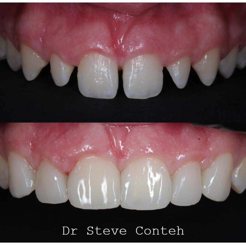 Composite bonding was used here to close the spaces, improve the shape of the teeth and provide a natural result.