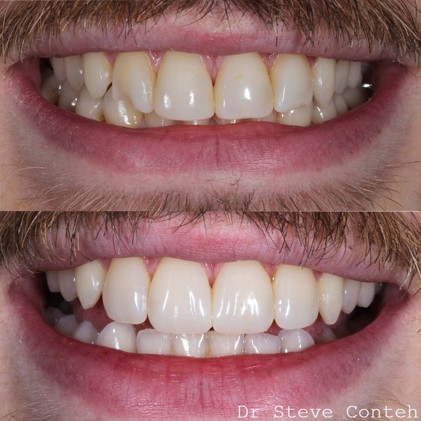 8 year old composite bonding, on the front four teeth have been replaced with new composite restorations to refresh this