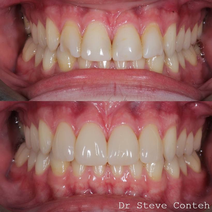 8 year old composite bonding, on the front four teeth have been replaced with new composite restorations to refresh this