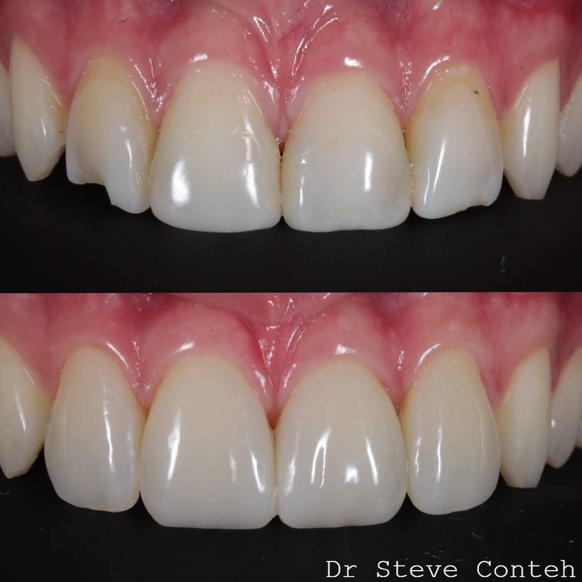 8 year old composite bonding, on the front four teeth have been replaced with new composite restorations to refresh this