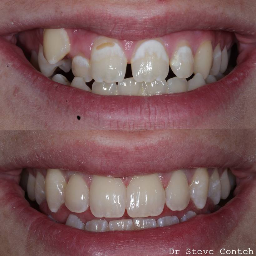 Orthodontic treatment with fixed braces improved the position of the teeth. Then composite bonding created a natural, un