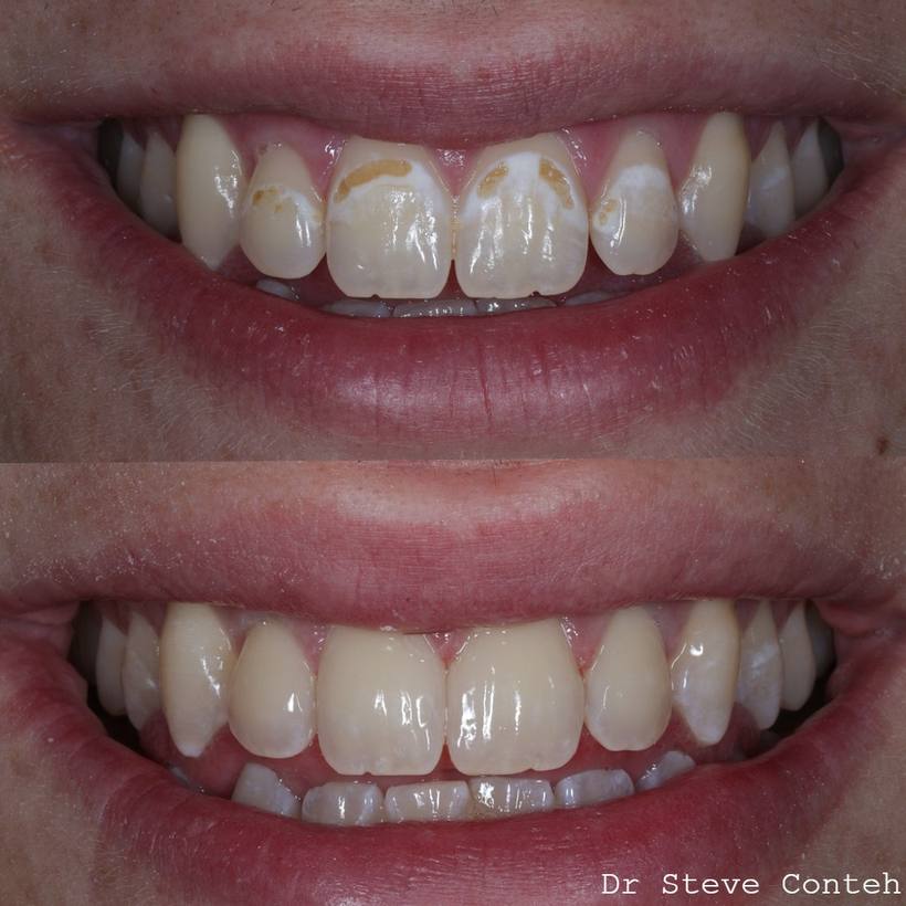 Orthodontic treatment with fixed braces improved the position of the teeth. Then composite bonding created a natural, un