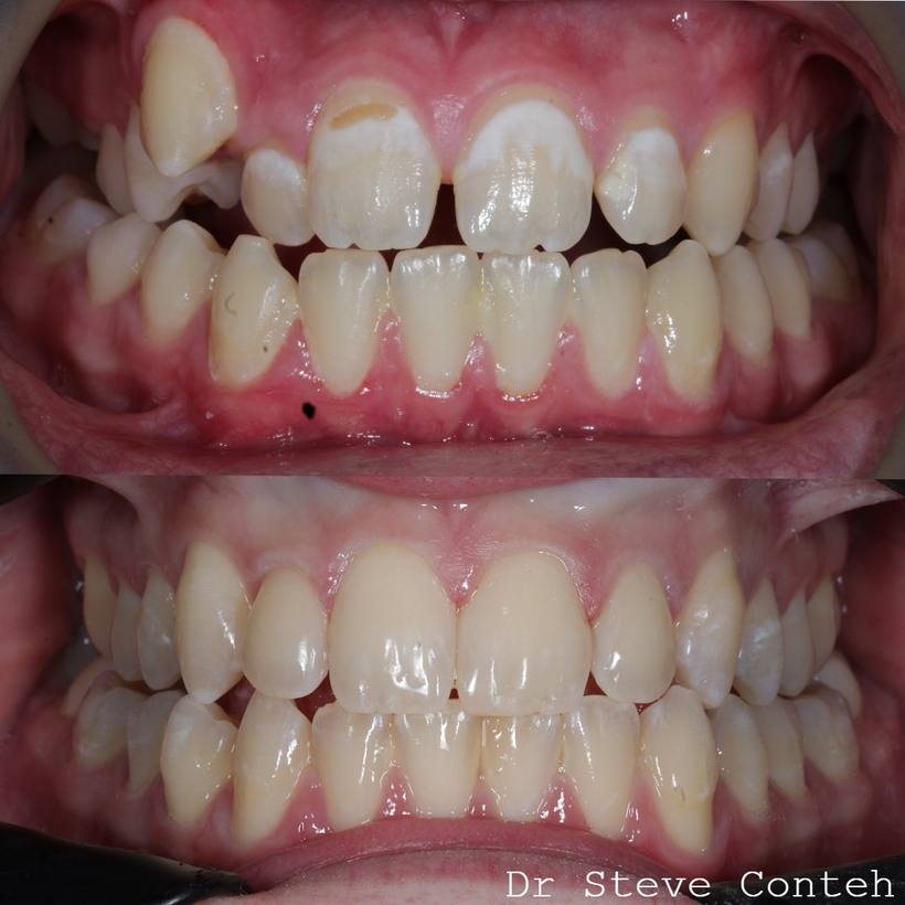 Orthodontic treatment with fixed braces improved the position of the teeth. Then composite bonding created a natural, un