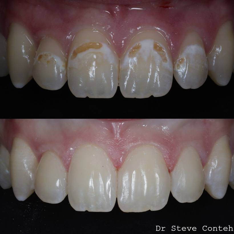 Composite bonding created a natural, uniformity to the teeth
