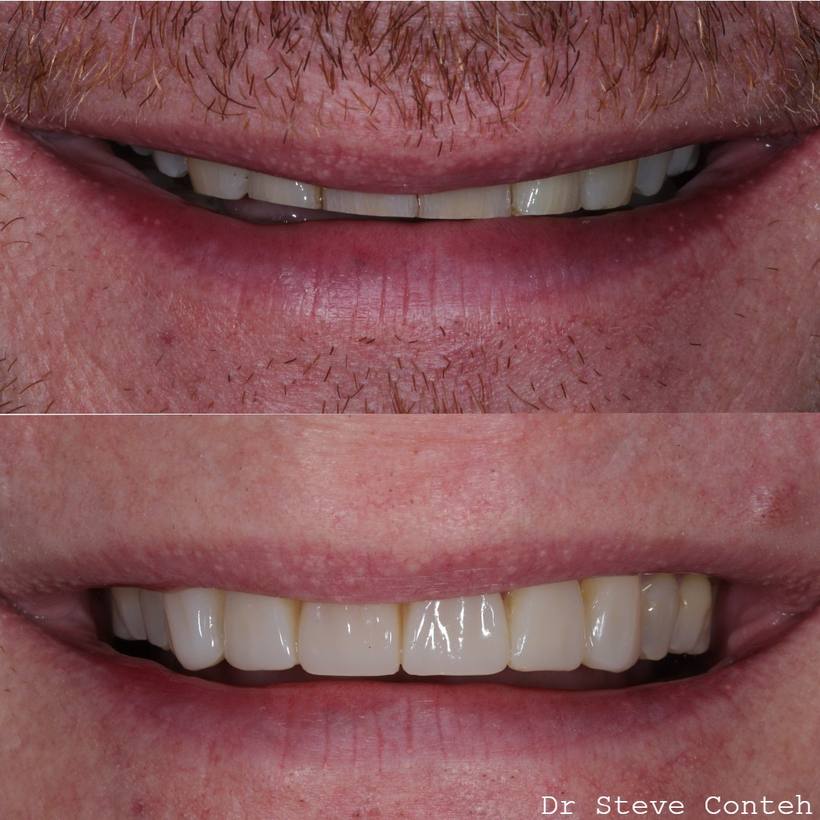 Composite restorations reversed the wear and age of this smile. Natural masculine were shapes selected here.
