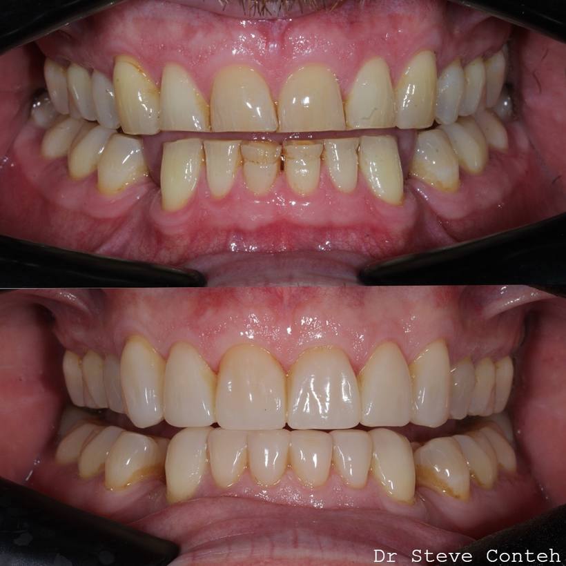 Composite restorations reversed the wear and age of this smile. Natural masculine were shapes selected here.