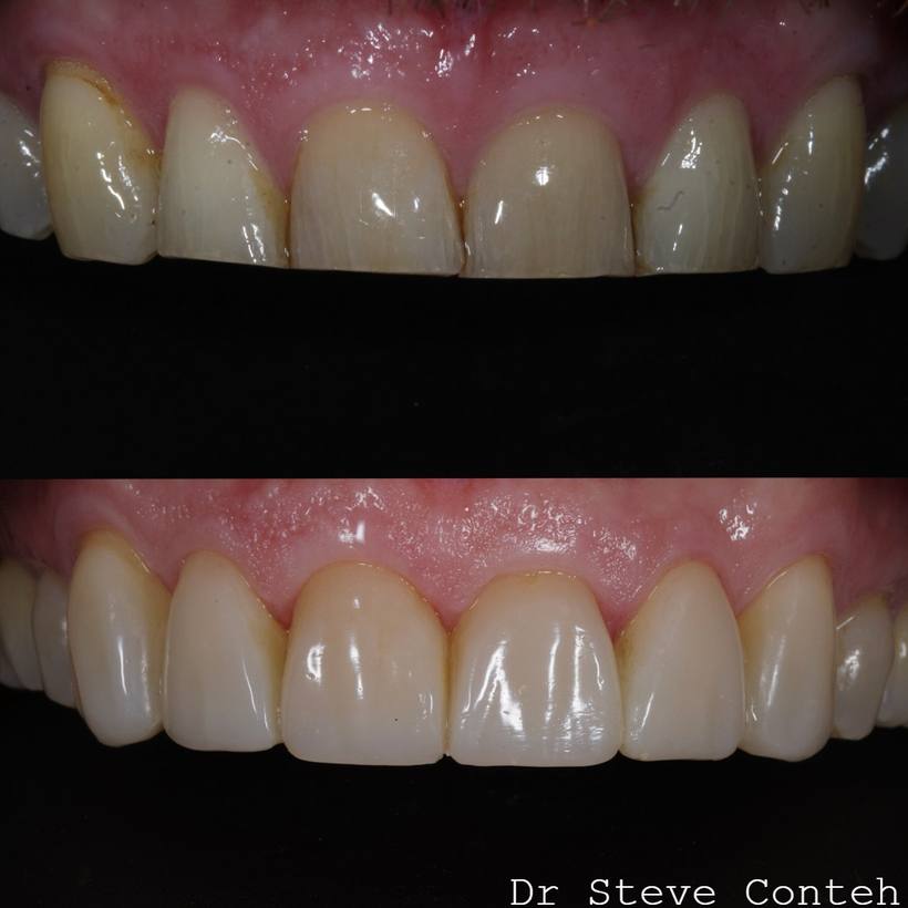 Composite restorations reversed the wear and age of this smile. Natural masculine were shapes selected here.