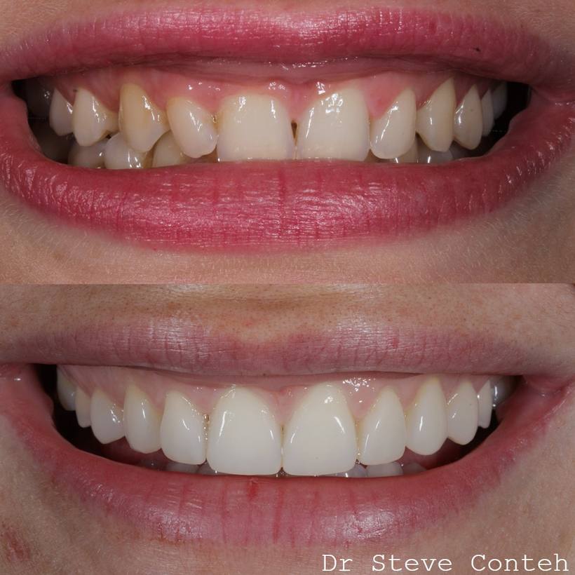 Invisalign, whitening and composite bonding techniques came together to create such a beautiful, harmonious smile for th