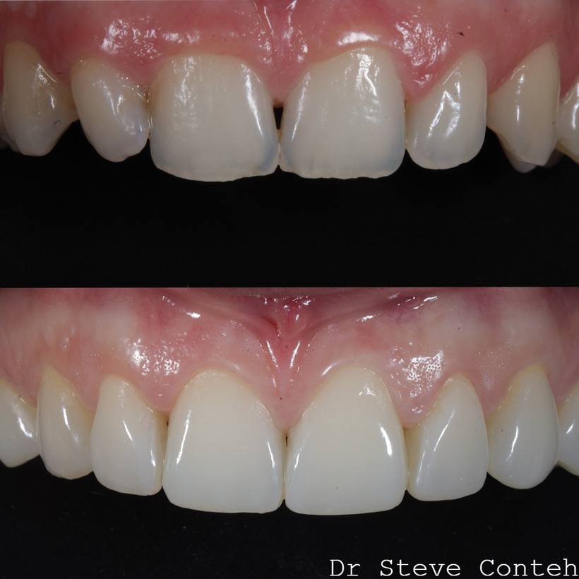 Invisalign, whitening and composite bonding techniques came together to create such a beautiful, harmonious smile for th
