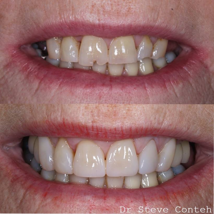 Composite bonding and implant crowns before and after