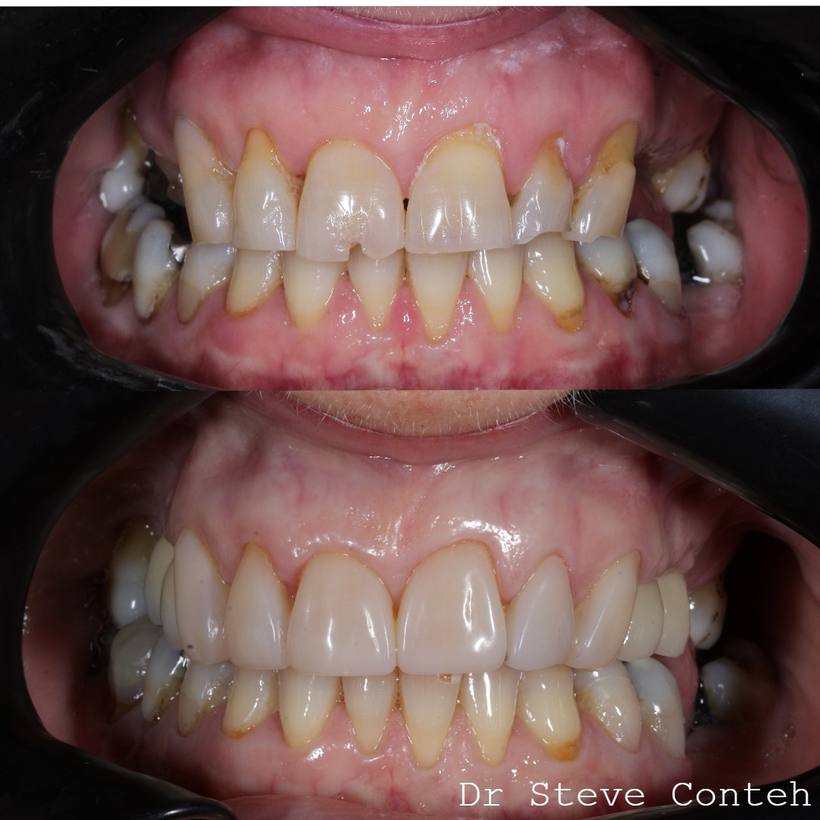 Composite bonding restored the worn front six teeth and implant crowns replaced four missing back teeth.