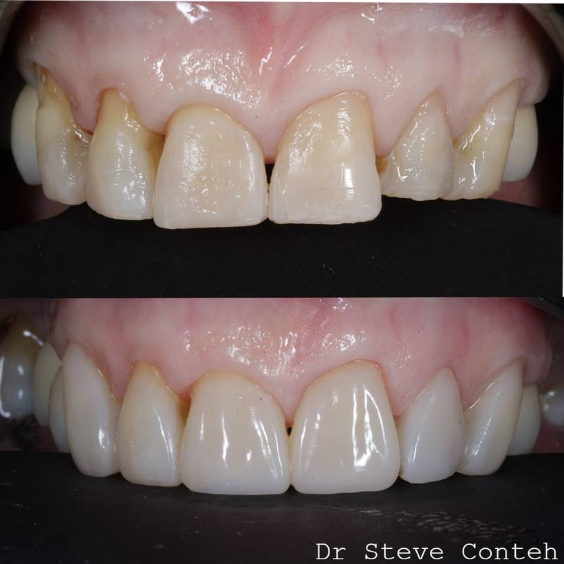 Composite bonding restored the worn front six teeth and implant crowns replaced four missing back teeth.