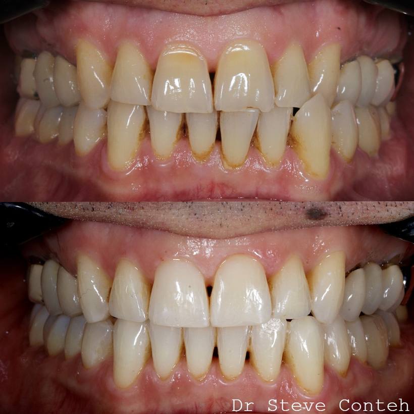 Invisalign, whitening and composite bonding techniques enhanced these teeth.