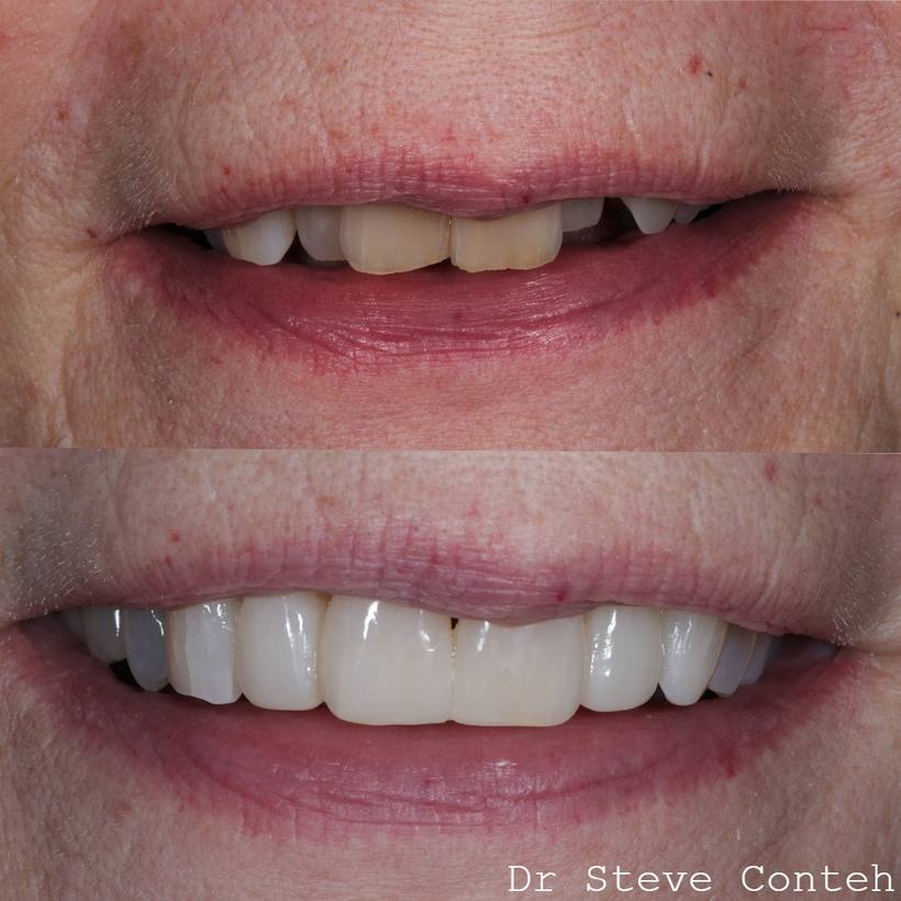 It’s never too late to achieve your dream smile. Your own teeth can look beautifully natural with the correct treatments