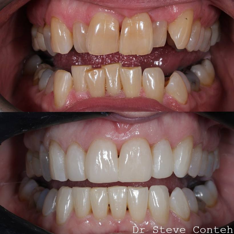 It’s never too late to achieve your dream smile. Your own teeth can look beautifully natural with the correct treatments