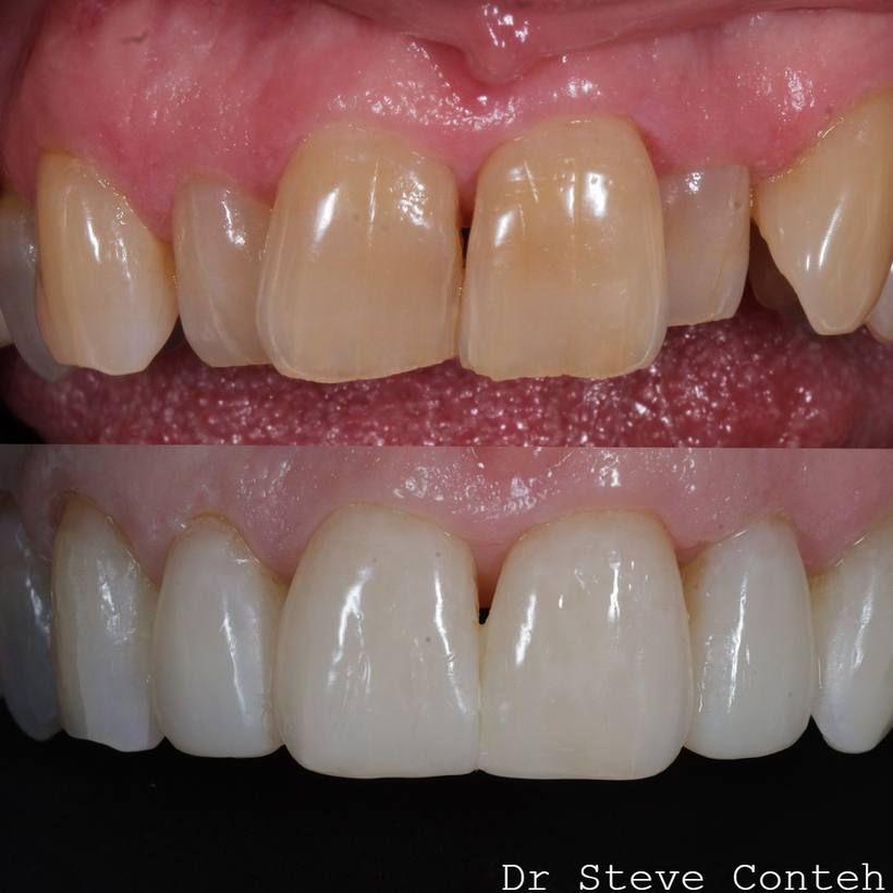 It’s never too late to achieve your dream smile. Your own teeth can look beautifully natural with the correct treatments