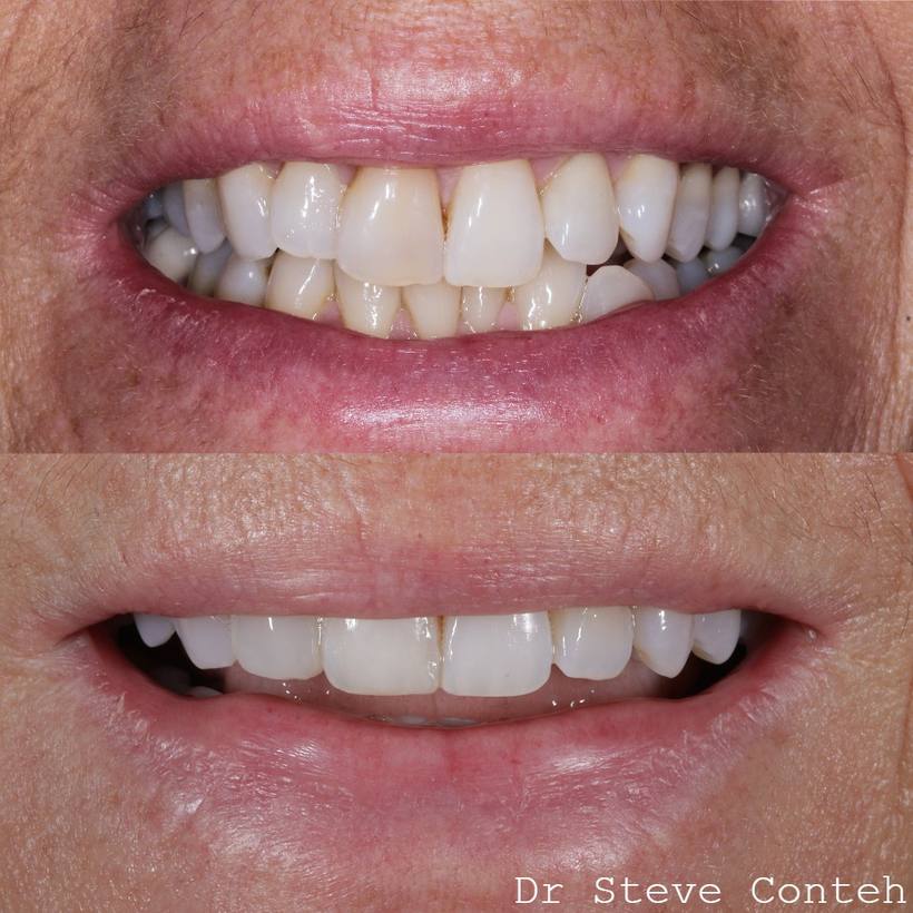 Your teeth but better. Invisalign improved the position of the teeth. Whitening improved the colour, and composite bondi