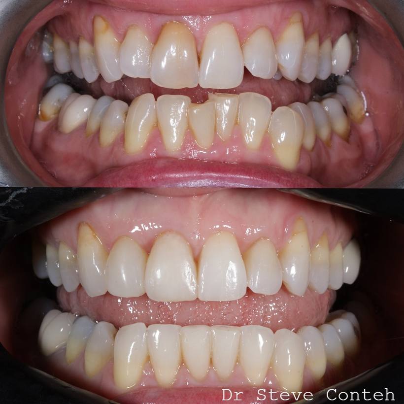 Your teeth but better. Invisalign improved the position of the teeth. Whitening improved the colour, and composite bondi