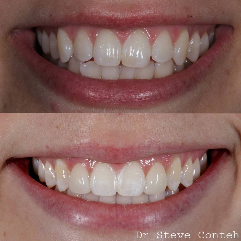 Alignment, whitening and bonding on two front teeth enhanced this smile.