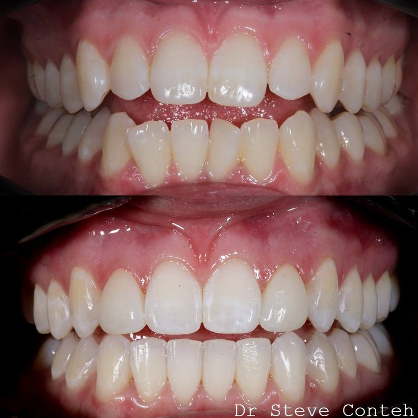 Alignment, whitening and bonding on two front teeth enhanced this smile.