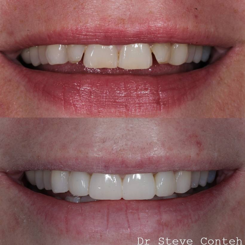 A - Align B - Brighten (whiten) C – Composite bonding