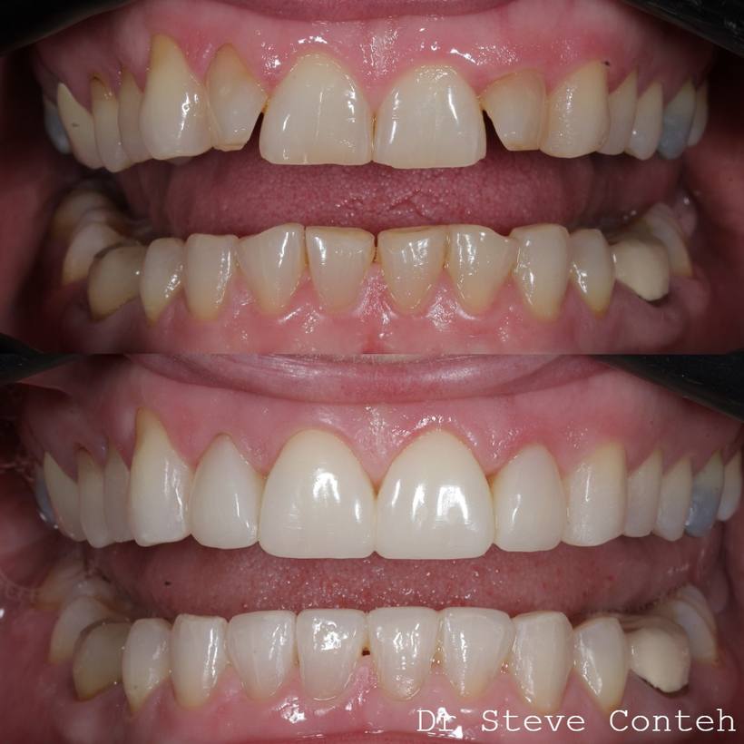 A - Align B - Brighten (whiten) C – Composite bonding on eight teeth