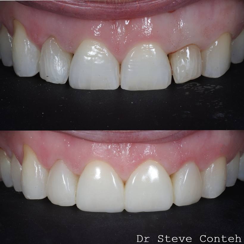 A - Align B - Brighten (whiten) C – Composite bonding on four teeth
