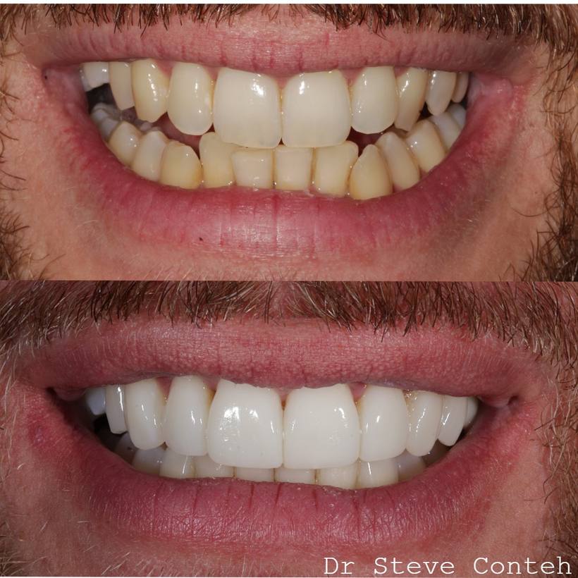 A - Align B - Brighten (whiten) C – Composite bonding
