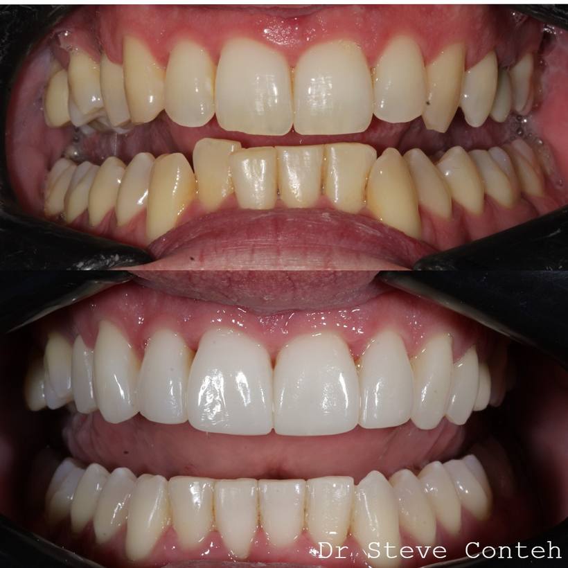 A - Align B - Brighten (whiten) C – Composite bonding