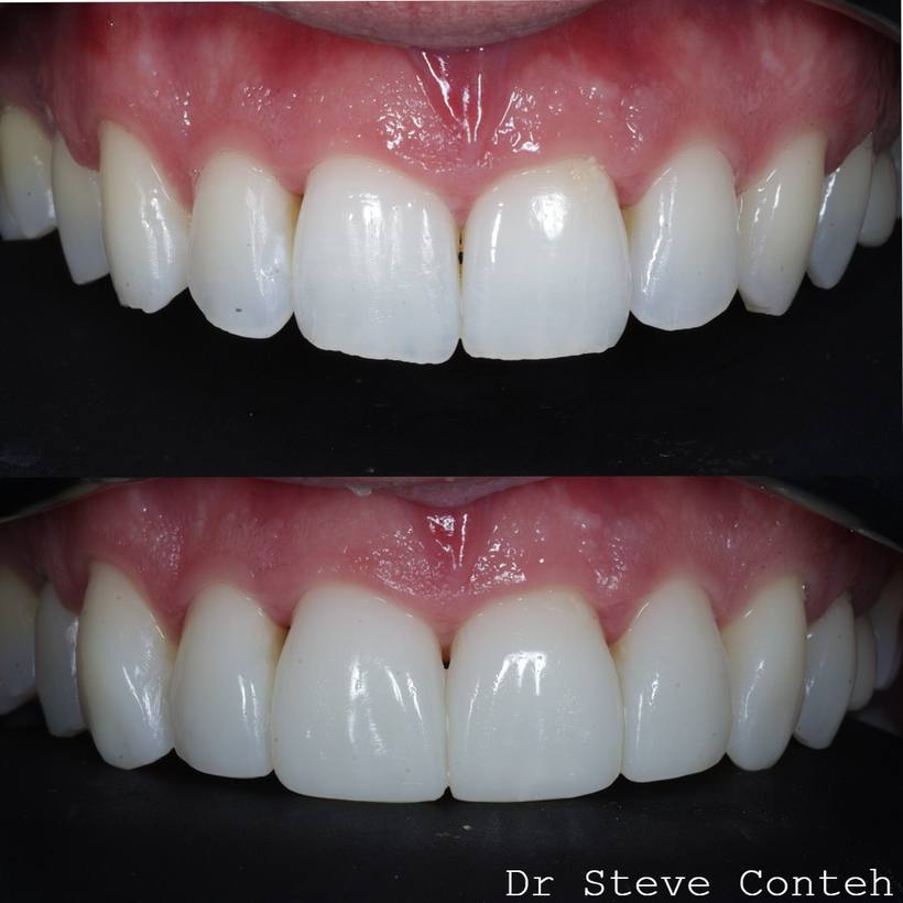 Composite bonding perfected this smile!